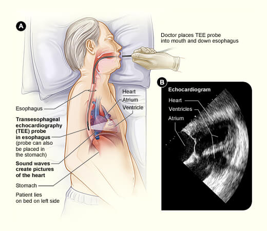 transesophageal-echocardiogram-tee-cardiovascular-consultants-ltd