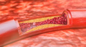 Peripheral Artery Disease (PAD)